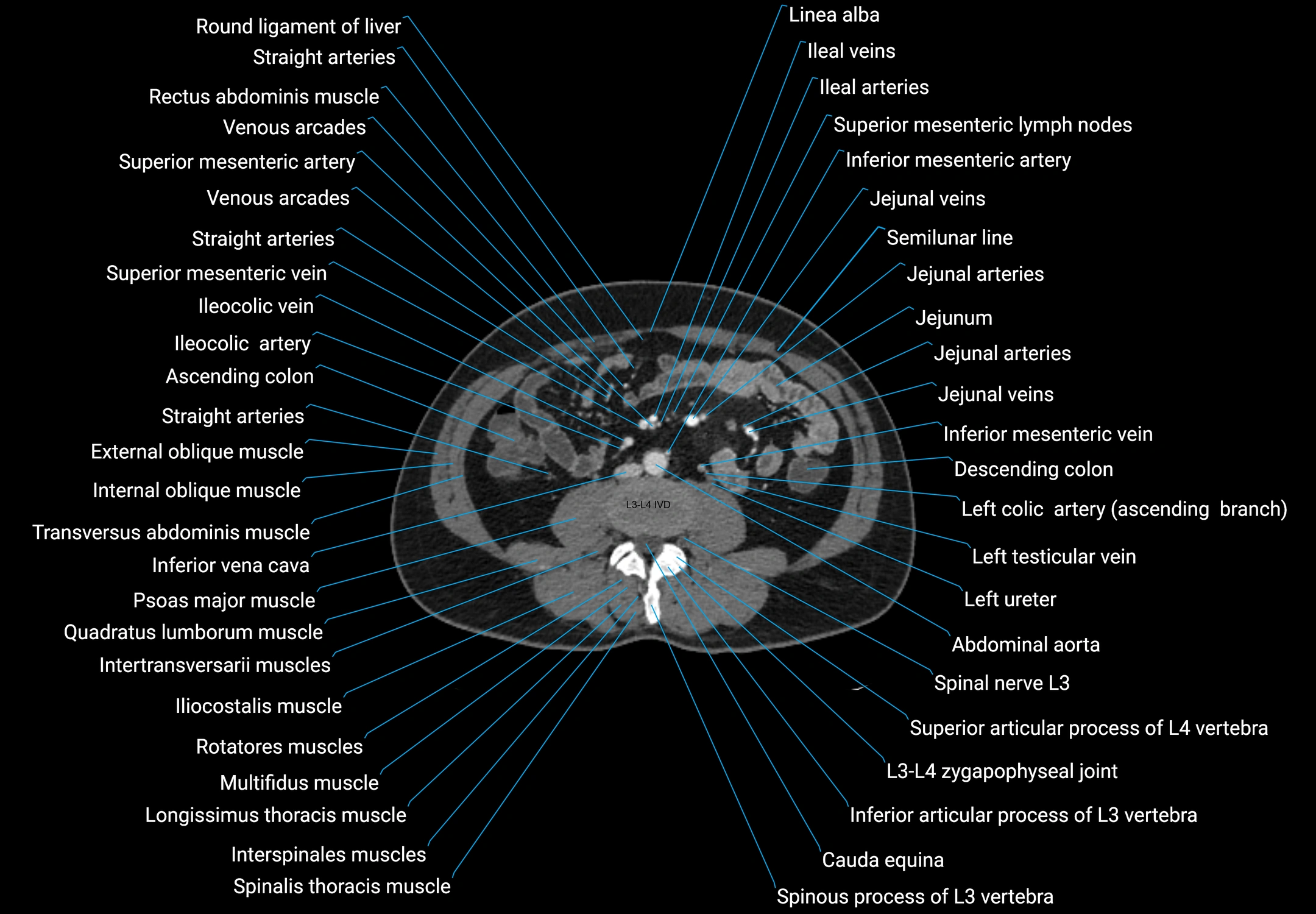 CT male pelvis axial cross sectional anatomy labelled radiology image -00099.webp